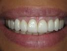 Smile-Design-After-Image