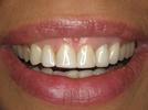 Smile-Design-Before-Image